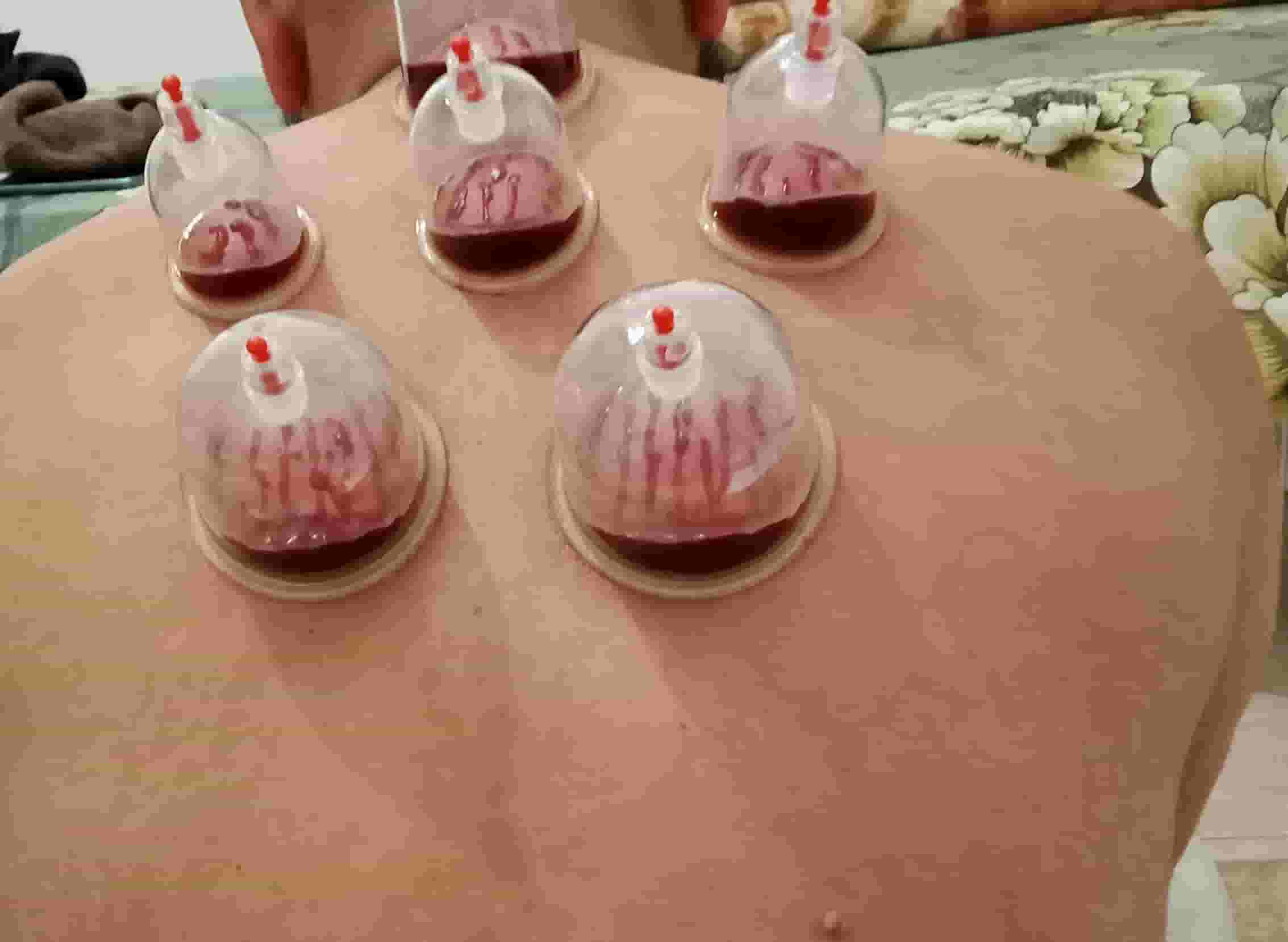  There is a long experience in therapeutic cupping