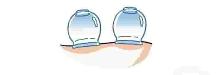 Hijama in all areas of Kuwait